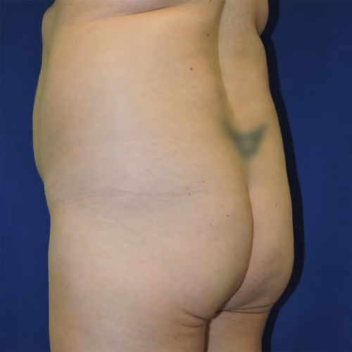 Liposuction before and after, case 7527 - Cool Springs Plastic Surgery
