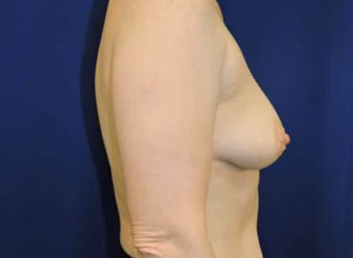 Breast Lift + Augmentation before and after, case 5539 - Cool Springs Plastic Surgery