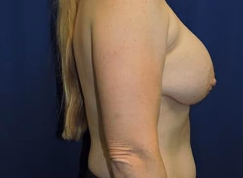 Breast Lift + Augmentation before and after, case 5539 - Cool Springs Plastic Surgery