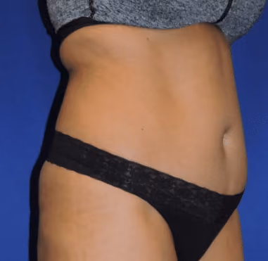 Liposuction before and after, case 7255 - Cool Springs Plastic Surgery