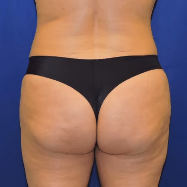 Liposuction before and after, case 7255 - Cool Springs Plastic Surgery