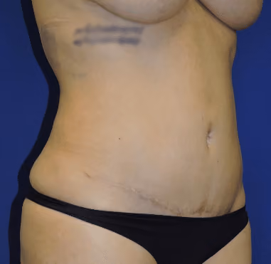 Liposuction before and after, case 7255 - Cool Springs Plastic Surgery