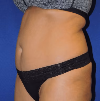 Liposuction before and after, case 7255 - Cool Springs Plastic Surgery