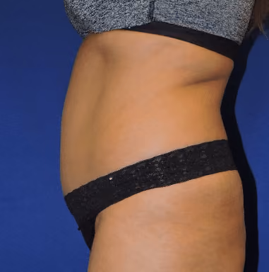 Liposuction before and after, case 7255 - Cool Springs Plastic Surgery