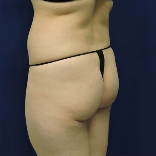 Liposuction before and after, case 7671 - Cool Springs Plastic Surgery