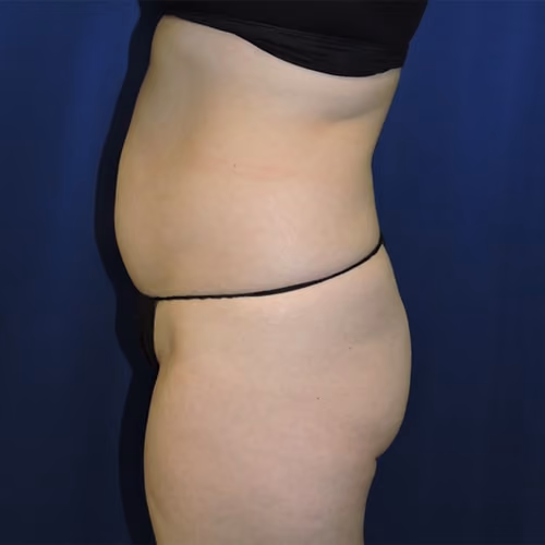 Liposuction before and after, case 7671 - Cool Springs Plastic Surgery