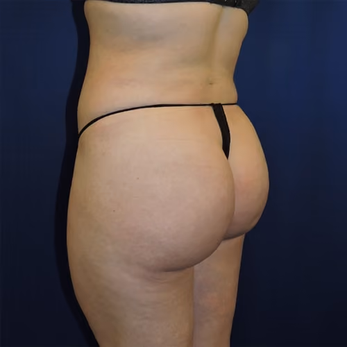 Liposuction before and after, case 7671 - Cool Springs Plastic Surgery