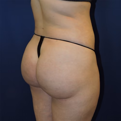 Liposuction before and after, case 7671 - Cool Springs Plastic Surgery