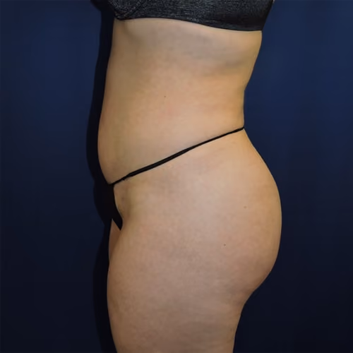 Liposuction before and after, case 7671 - Cool Springs Plastic Surgery