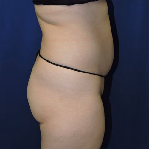 Liposuction before and after, case 7671 - Cool Springs Plastic Surgery