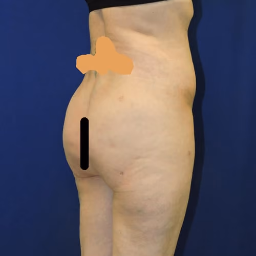 Liposuction before and after, case 7873 - Cool Springs Plastic Surgery
