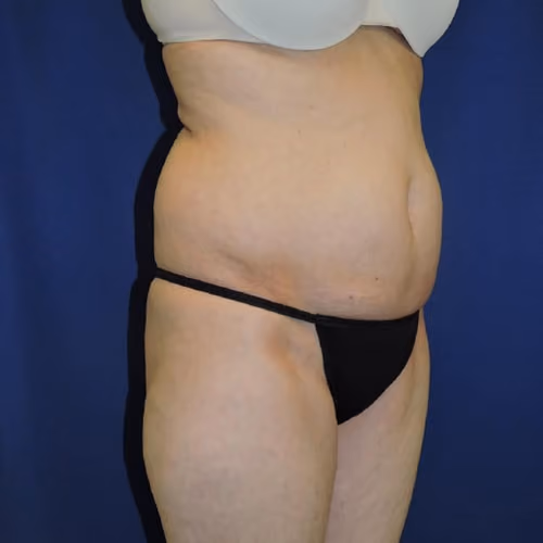 Liposuction before and after, case 7873 - Cool Springs Plastic Surgery