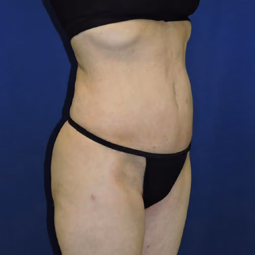 Liposuction before and after, case 7873 - Cool Springs Plastic Surgery