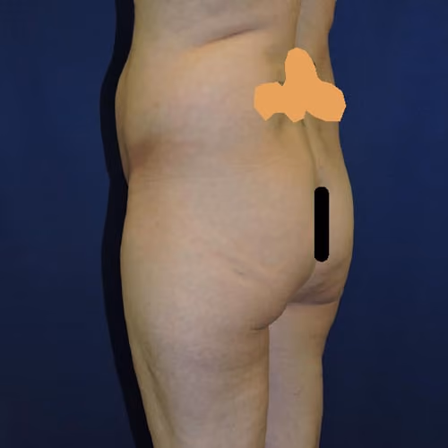 Liposuction before and after, case 7873 - Cool Springs Plastic Surgery