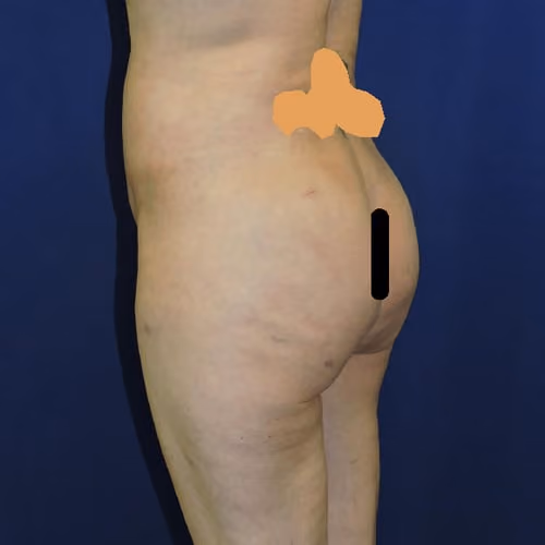 Liposuction before and after, case 7873 - Cool Springs Plastic Surgery