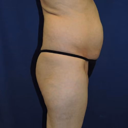 Liposuction before and after, case 7873 - Cool Springs Plastic Surgery