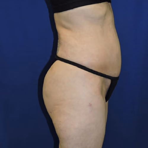 Liposuction before and after, case 7873 - Cool Springs Plastic Surgery