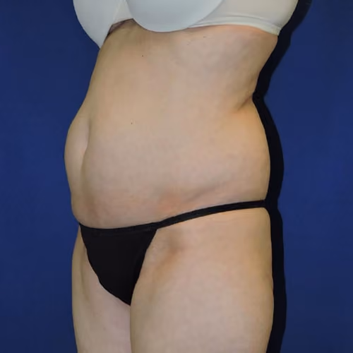 Liposuction before and after, case 7873 - Cool Springs Plastic Surgery