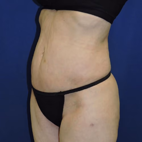 Liposuction before and after, case 7873 - Cool Springs Plastic Surgery