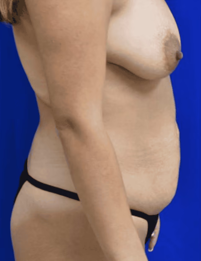 Mommy Makeover before and after, Dr. Sarosiek, case 13010 - Cool Springs Plastic Surgery