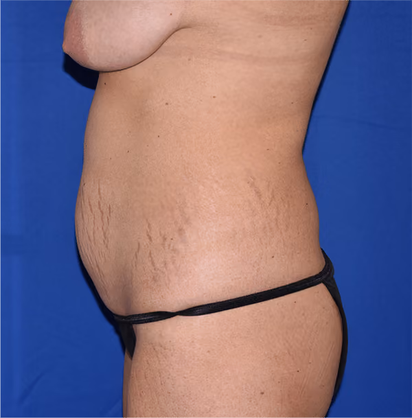 Mommy Makeover before and after, case 6293 - Cool Springs Plastic Surgery