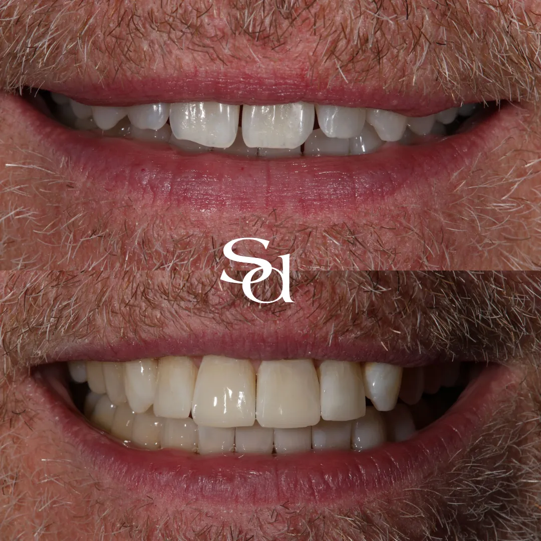 Clear aligners and composite bonding