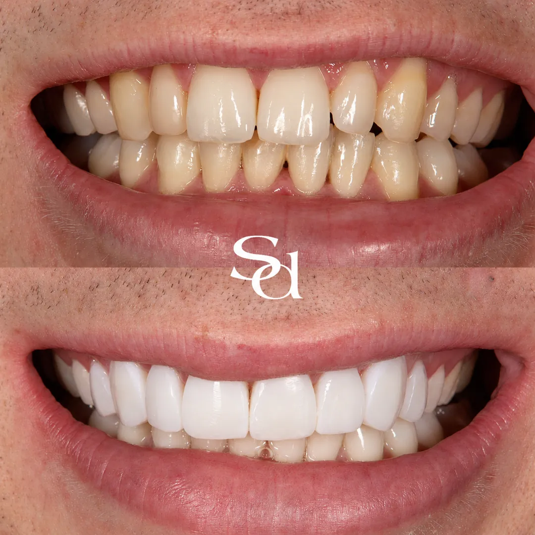 Composite bonding and whitening