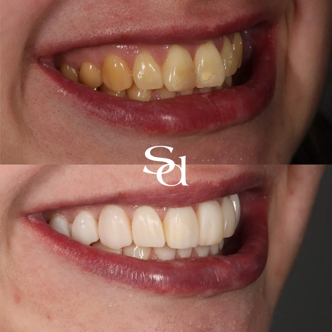 Porcelain veneers and whitening