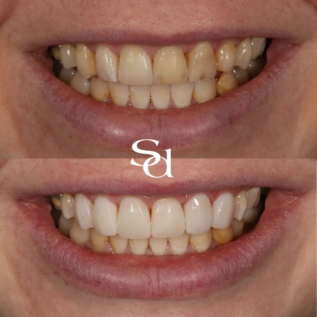 Porcelain veneers