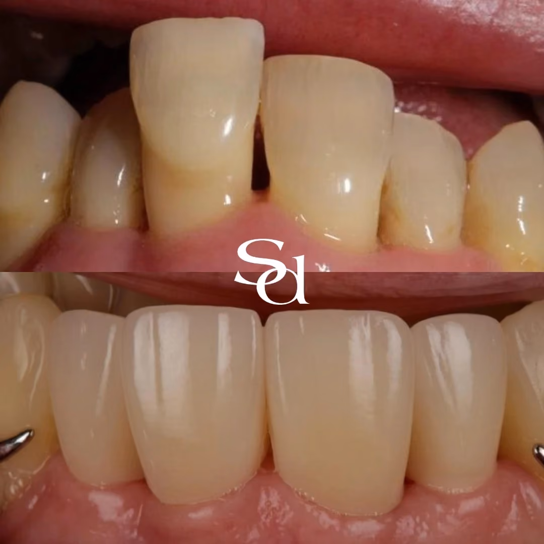 Smile makeover before and after at Sale Dental Spa: damaged front teeth restored with new crowns, by Dr Hamza Mirza. Un-retouched.
