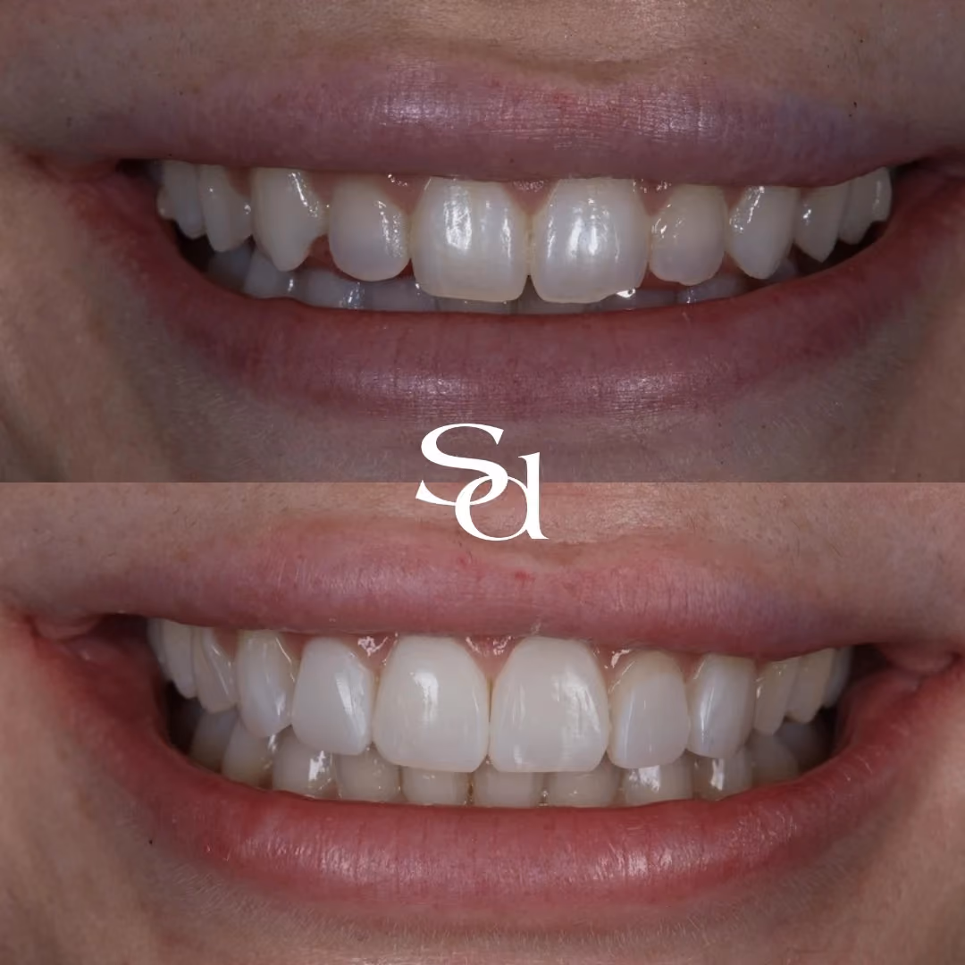 Smile makeover before and after at Sale Dental Spa: gaps closed and smile evened out, by Dr Hamza Mirza. Un-retouched.