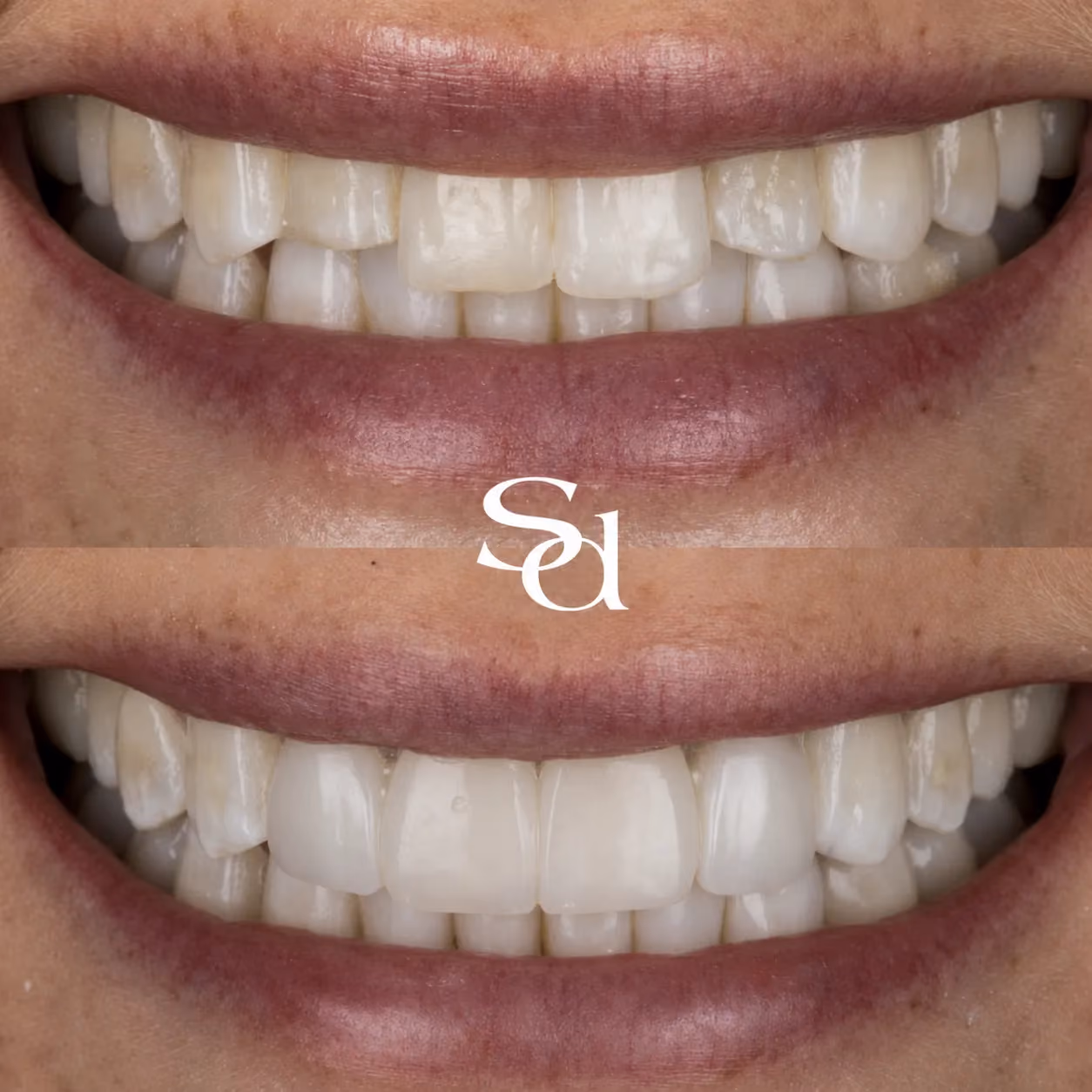 Smile makeover before and after at Sale Dental Spa: discoloured, uneven teeth refreshed in a smile makeover. Un-retouched.