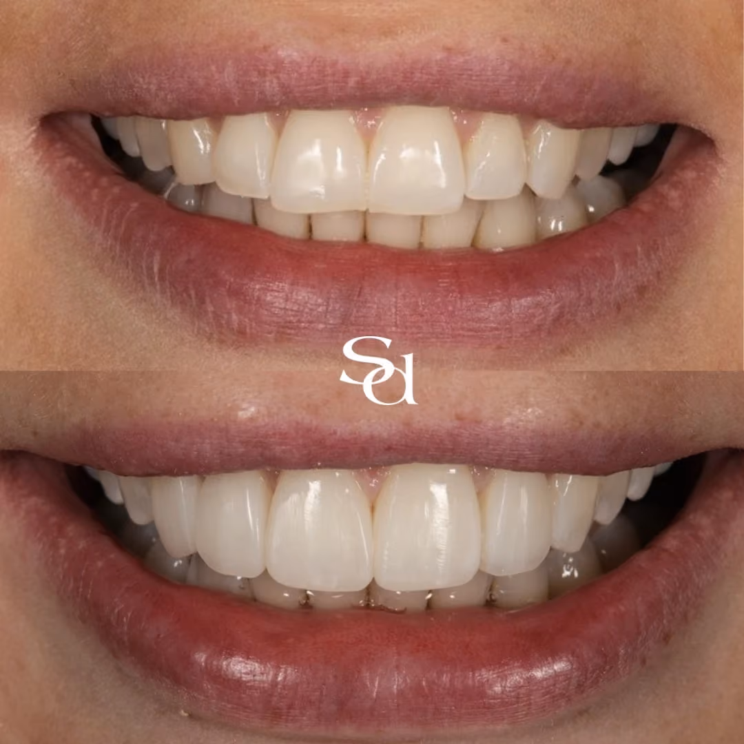 Smile makeover before and after at Sale Dental Spa: front teeth refined for a brighter, more even smile, by Dr Hamza Mirza. Un-retouched.