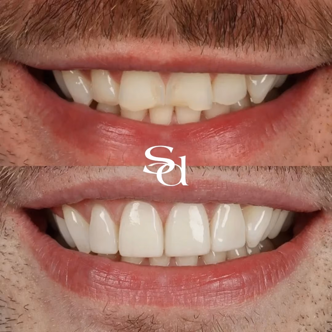 Porcelain veneers before and after at Sale Dental Spa: chipped, uneven front teeth transformed with porcelain veneers. Un-retouched.