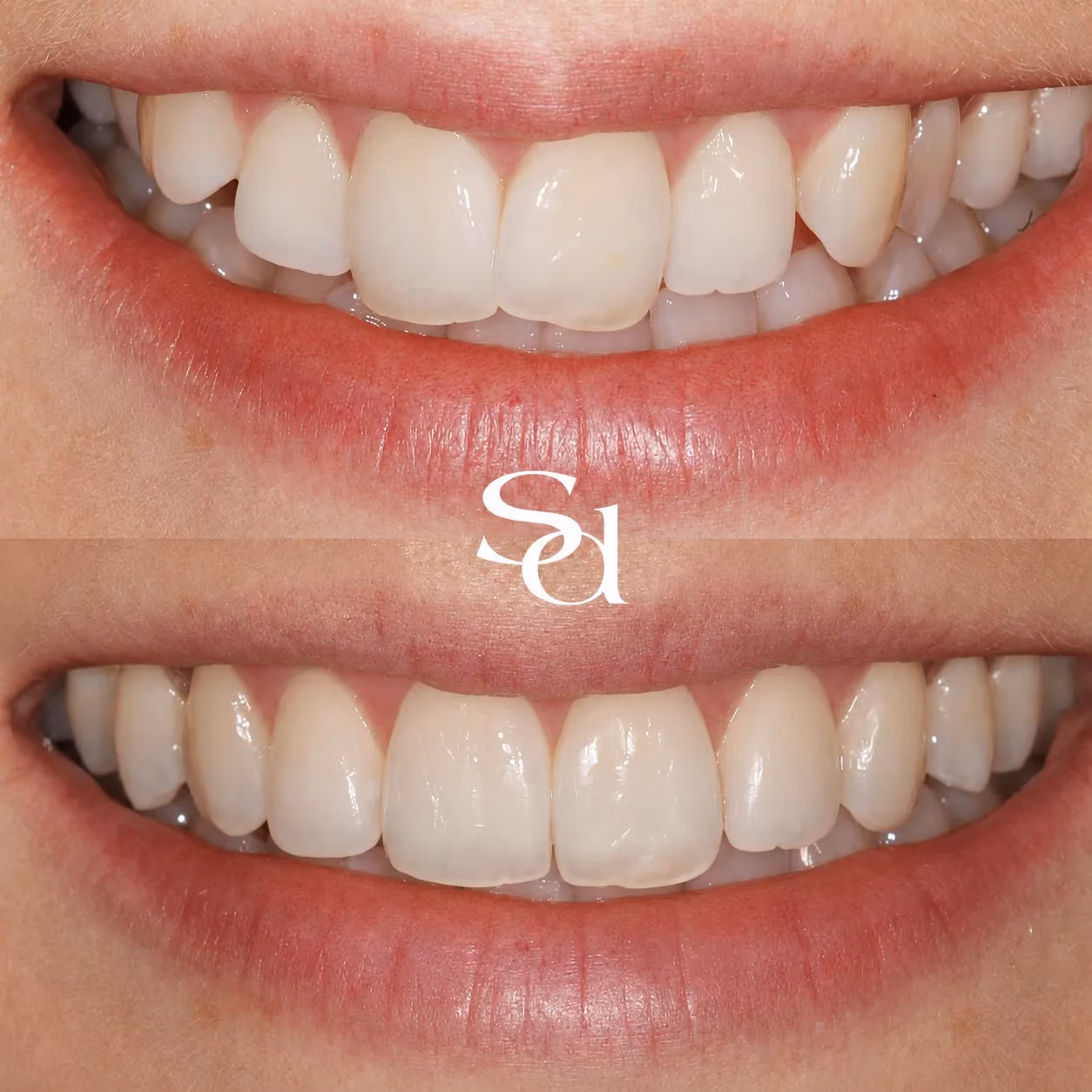 Smile makeover before and after at Sale Dental Spa: brighter, more even smile after a smile makeover. Un-retouched.