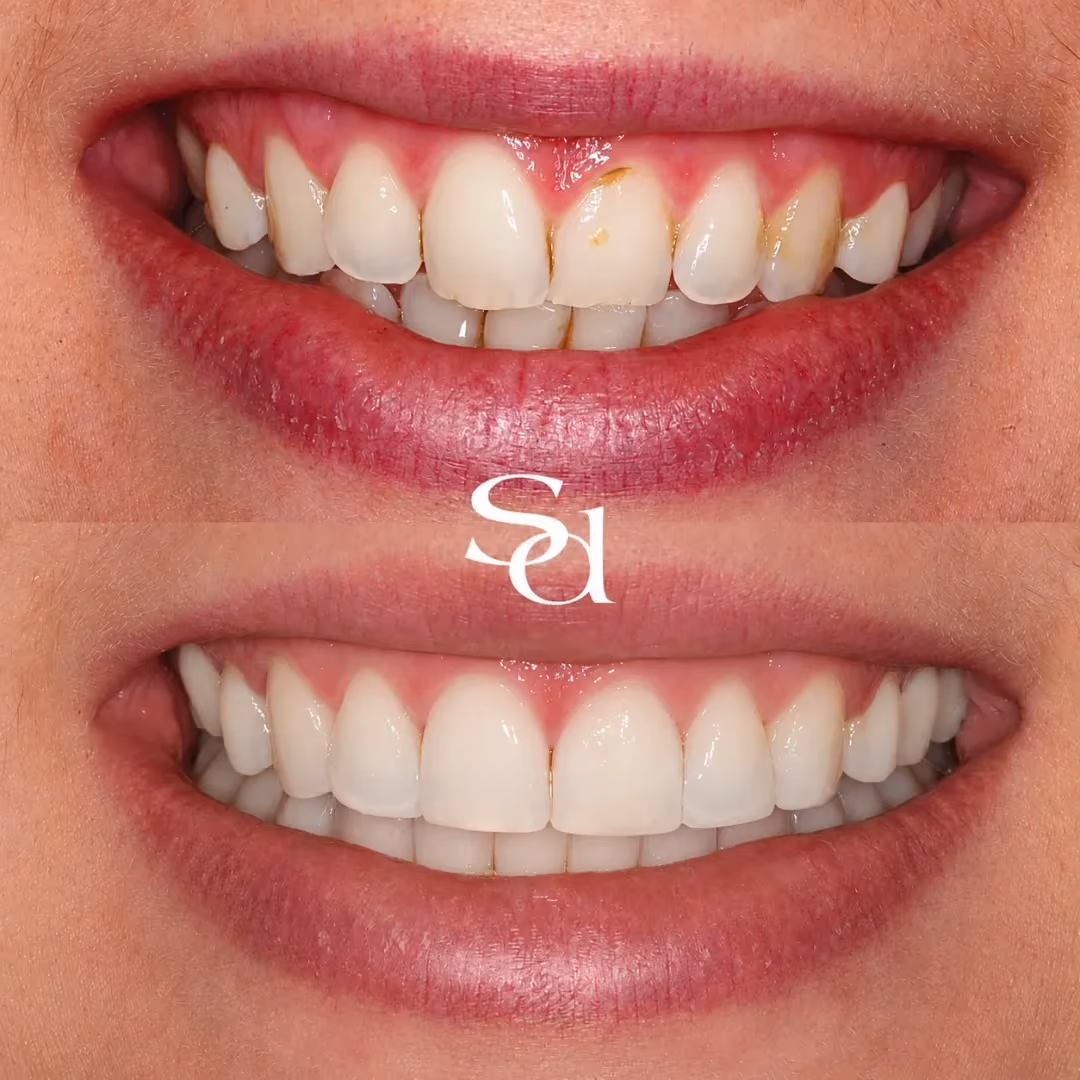 Invisalign and composite bonding before and after at Sale Dental Spa: gaps and rotations corrected with Invisalign and bonding, by Dr Aisha Ahmed. Un-retouched.