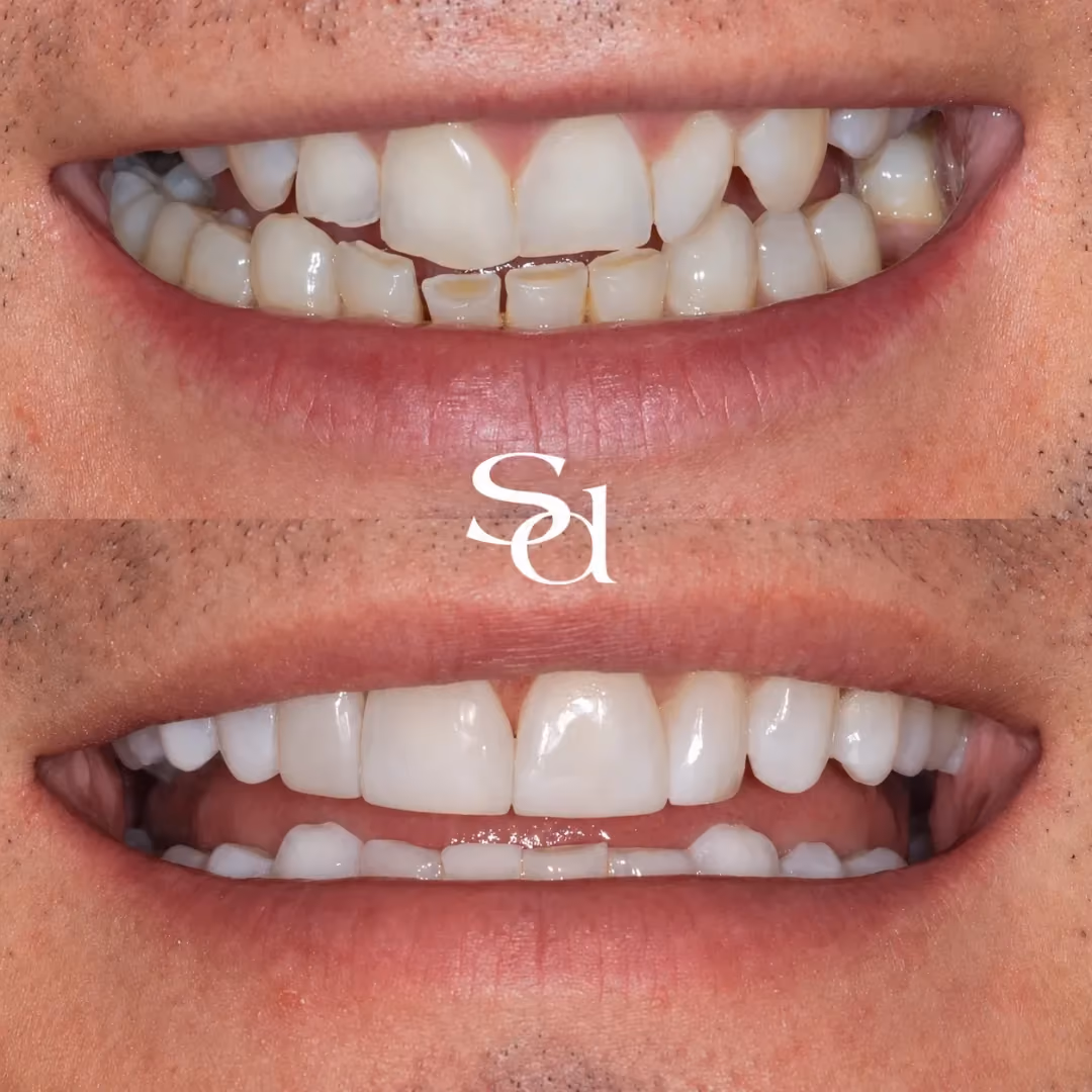 Invisalign and composite bonding before and after at Sale Dental Spa: crowding corrected with Invisalign and edges refined with bonding, by Dr Aisha Ahmed. Un-retouched.