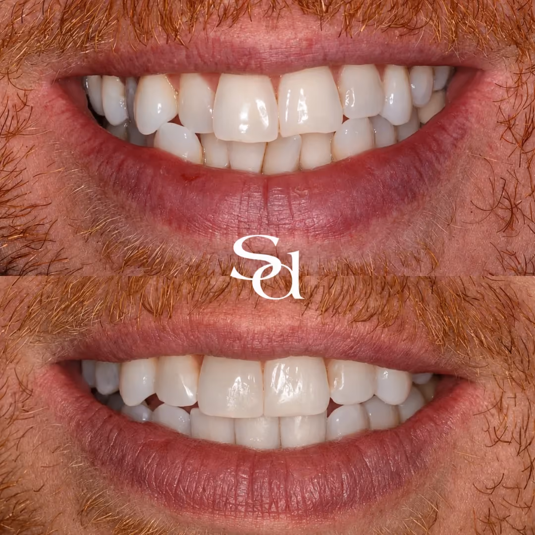 Invisalign and composite bonding before and after at Sale Dental Spa: teeth straightened with Invisalign then finished with composite bonding, by Dr Aisha Ahmed. Un-retouched.