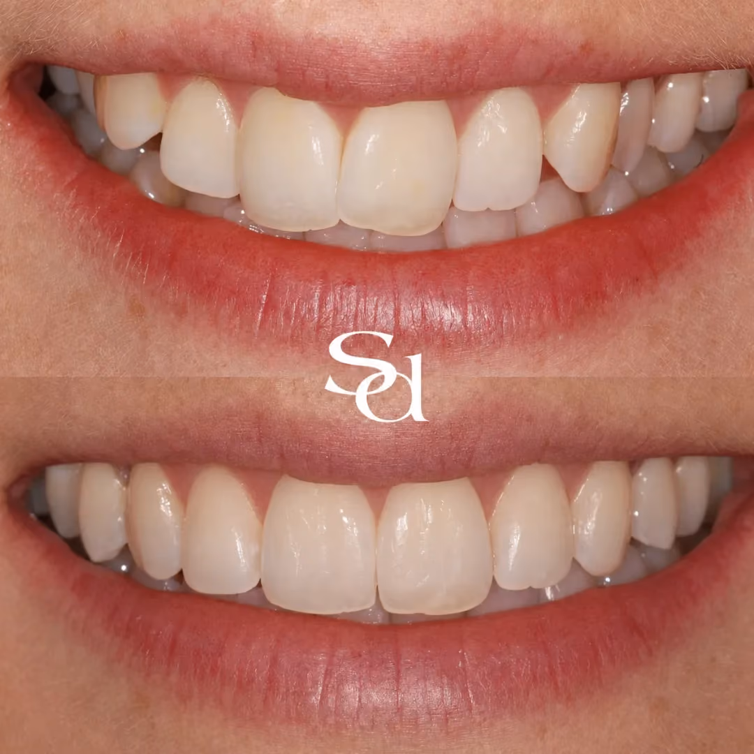 Invisalign before and after at Sale Dental Spa: smile straightened with Invisalign clear aligners, by Dr Aisha Ahmed. Un-retouched.