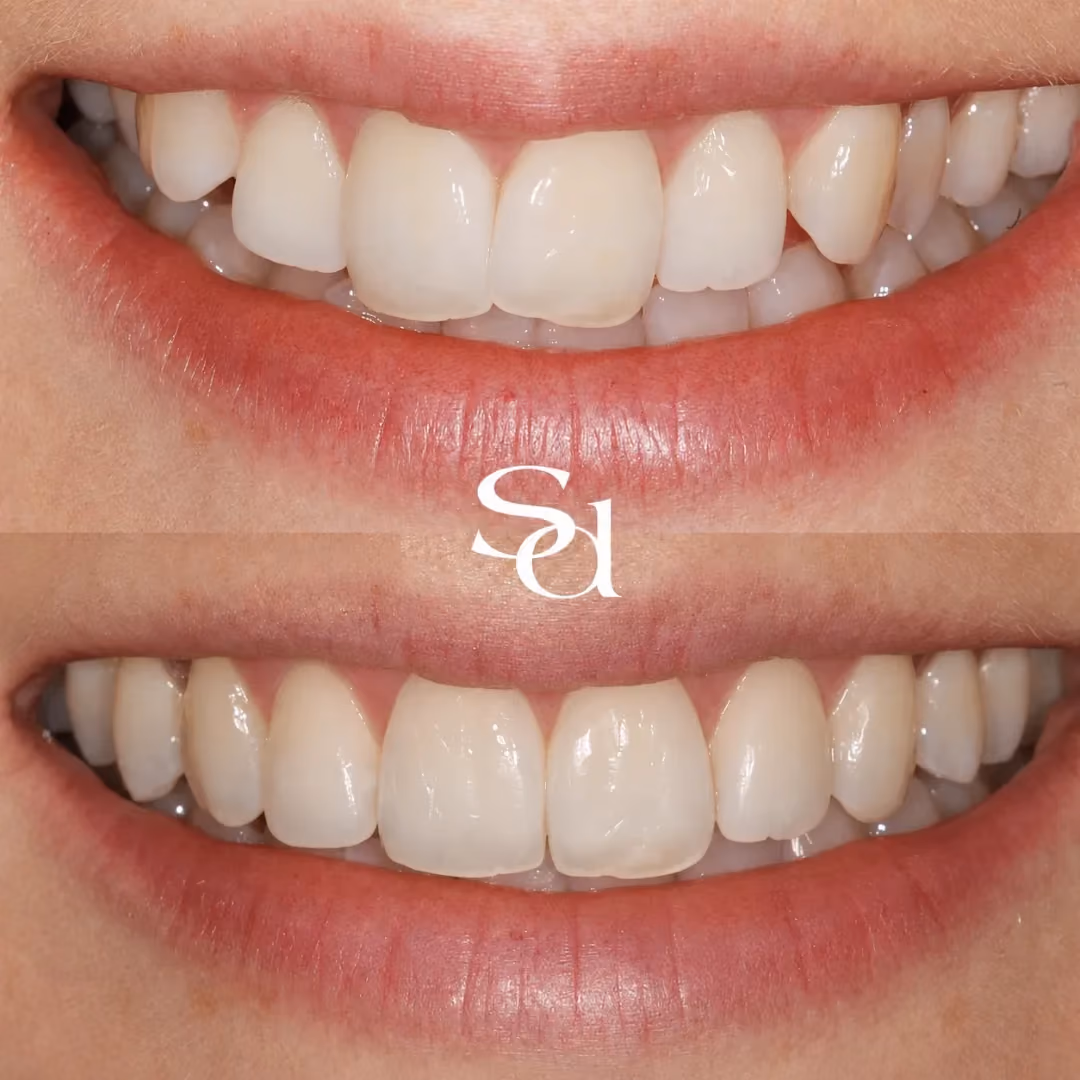 Invisalign before and after at Sale Dental Spa: crooked teeth straightened with Invisalign clear aligners, by Dr Aisha Ahmed. Un-retouched.