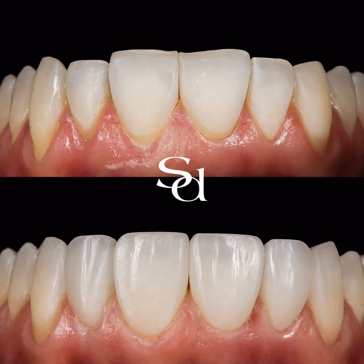 Composite bonding before and after at Sale Dental Spa: worn front edges restored with composite bonding, by Dr Hamza Mirza. Un-retouched.