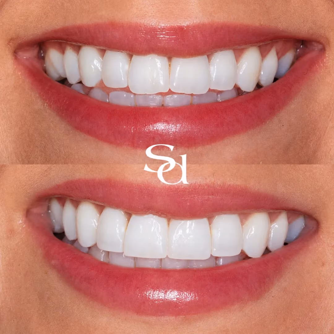 Composite bonding before and after at Sale Dental Spa: front teeth rebuilt and evened out with composite bonding, by Dr Aisha Ahmed. Un-retouched.