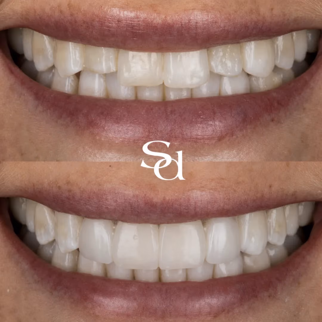 Composite bonding before and after at Sale Dental Spa: uneven front teeth reshaped with composite bonding, by Dr Aisha Ahmed. Un-retouched.