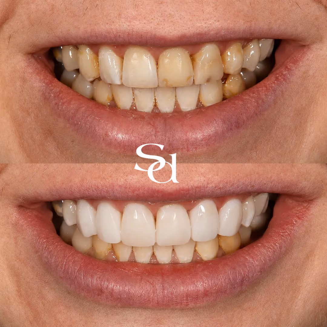 Porcelain veneers before and after at Sale Dental Spa: front teeth reshaped and brightened with porcelain veneers, by Dr Hamza Mirza. Un-retouched.