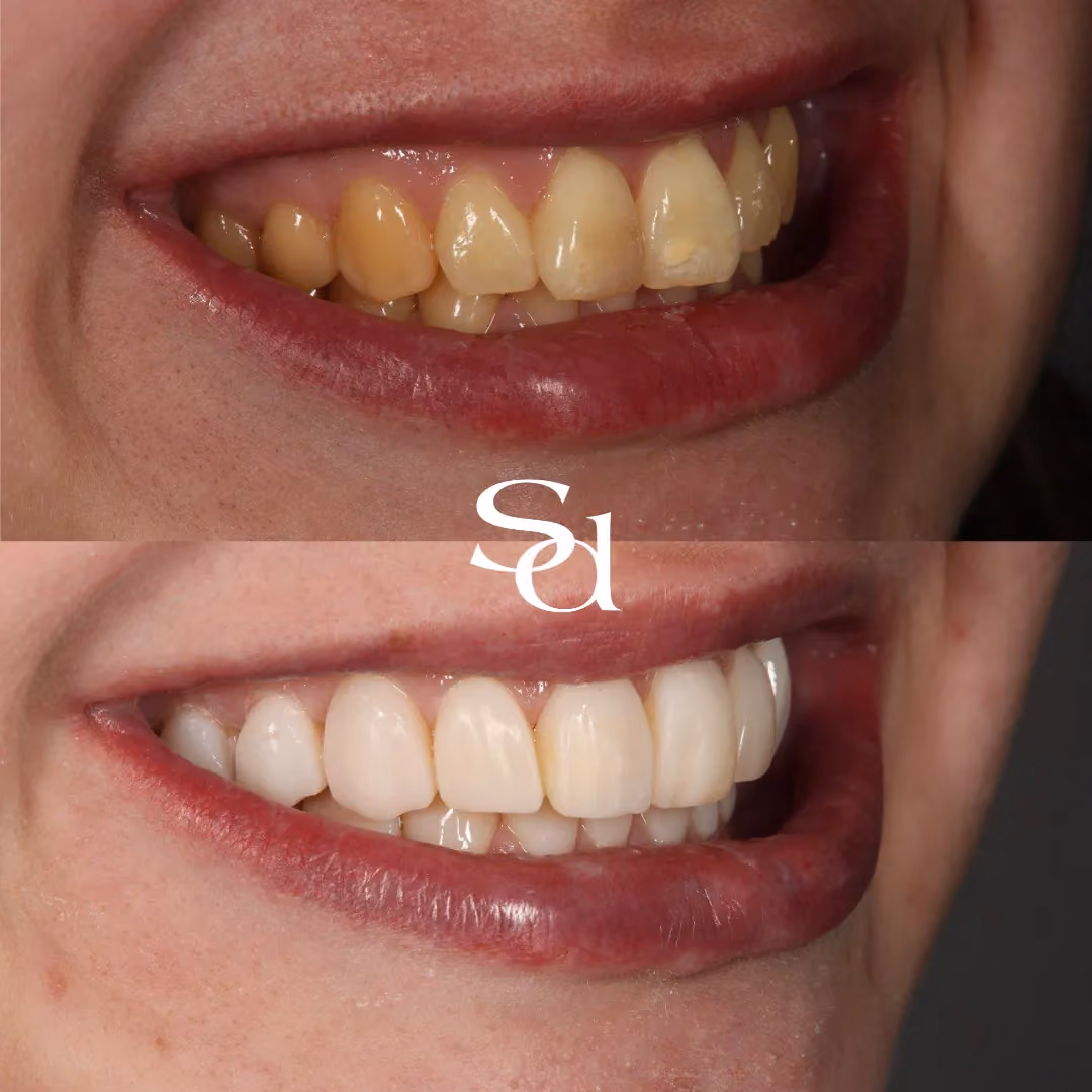 Porcelain veneers and whitening before and after at Sale Dental Spa: brighter, more uniform smile with veneers and whitening, by Dr Hamza Mirza. Un-retouched.