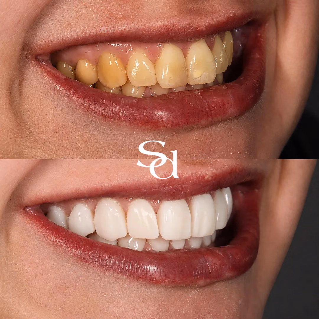 Porcelain veneers and whitening before and after at Sale Dental Spa: stained, uneven teeth replaced with a natural white smile, by Dr Hamza Mirza. Un-retouched.