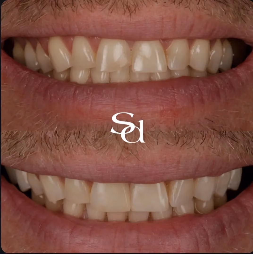 Same-day emergency repair before and after at Sale Dental Spa: broken front tooth rebuilt with composite bonding the same day, by Dr Aisha Ahmed. Un-retouched.