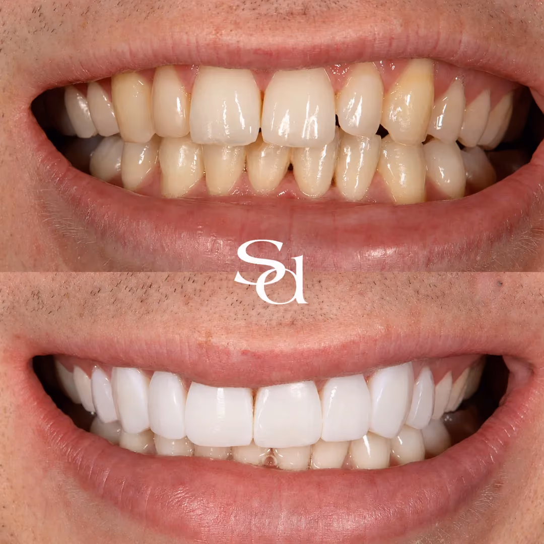 Composite bonding and whitening before and after at Sale Dental Spa: front teeth brightened and reshaped, by Dr Hamza Mirza. Un-retouched.