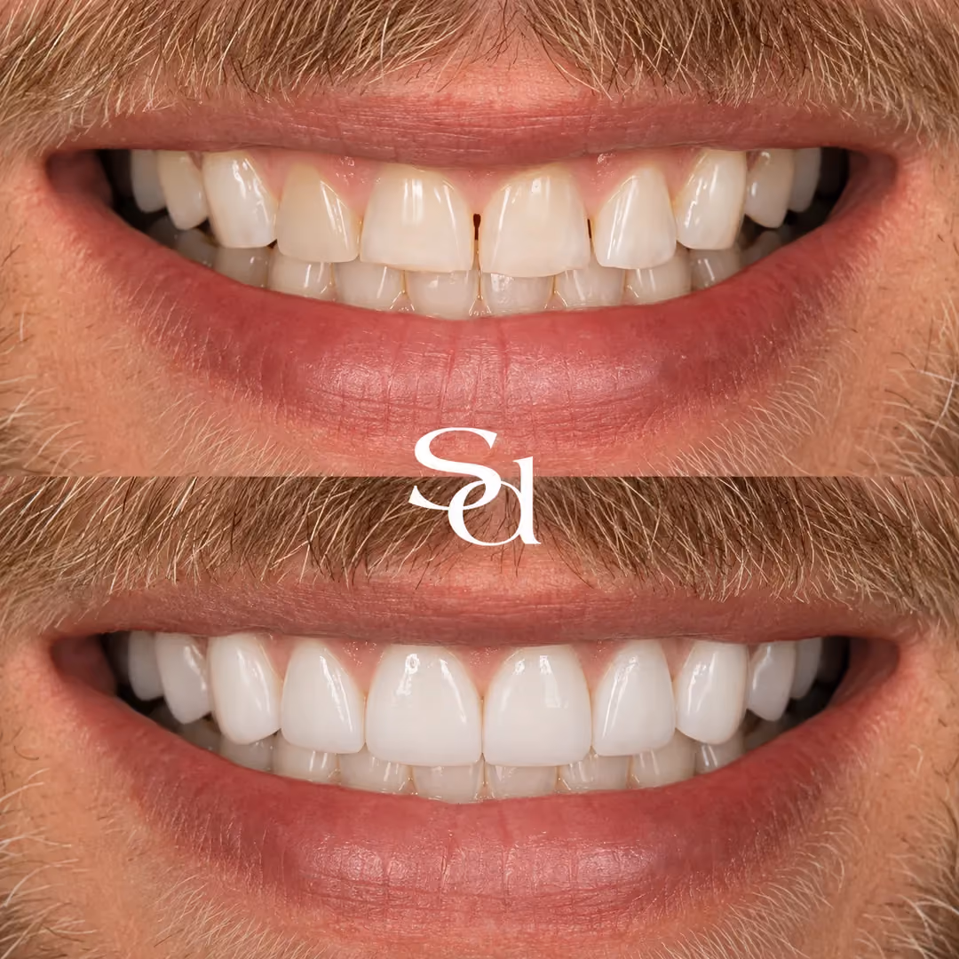 Composite bonding before and after at Sale Dental Spa: chipped front teeth repaired with composite bonding, by Dr Aisha Ahmed. Un-retouched.