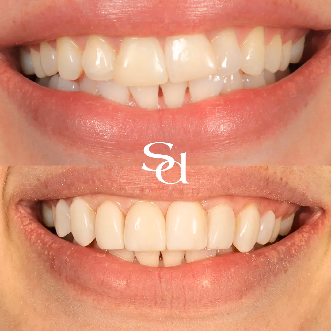 Composite bonding before and after at Sale Dental Spa: gaps closed and edges evened with composite bonding, by Dr Aisha Ahmed. Un-retouched.
